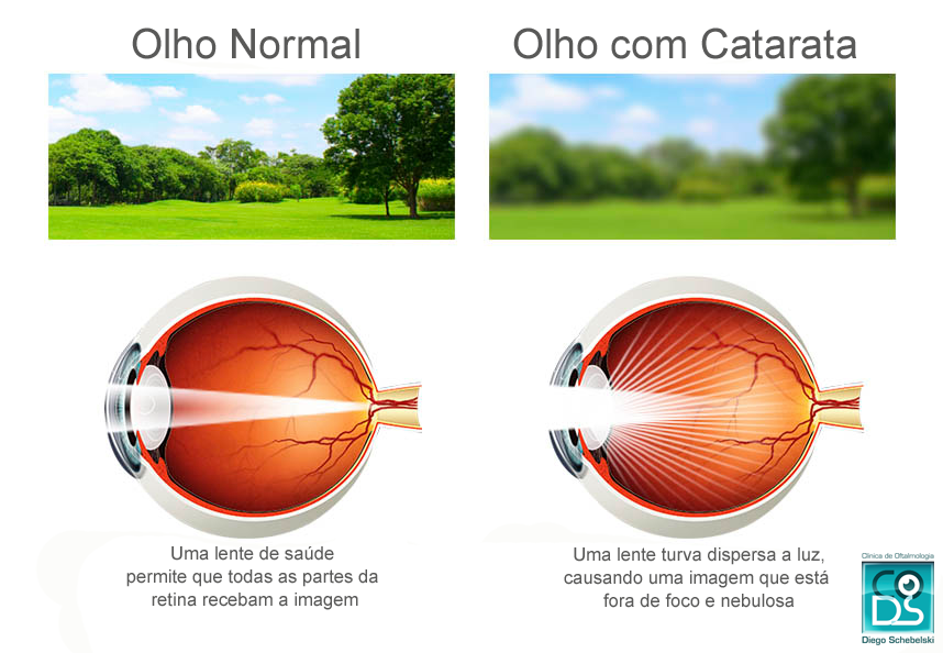 Olho Normal x Olho Com Catarata