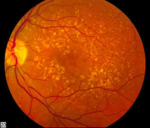 Degeneração Macular